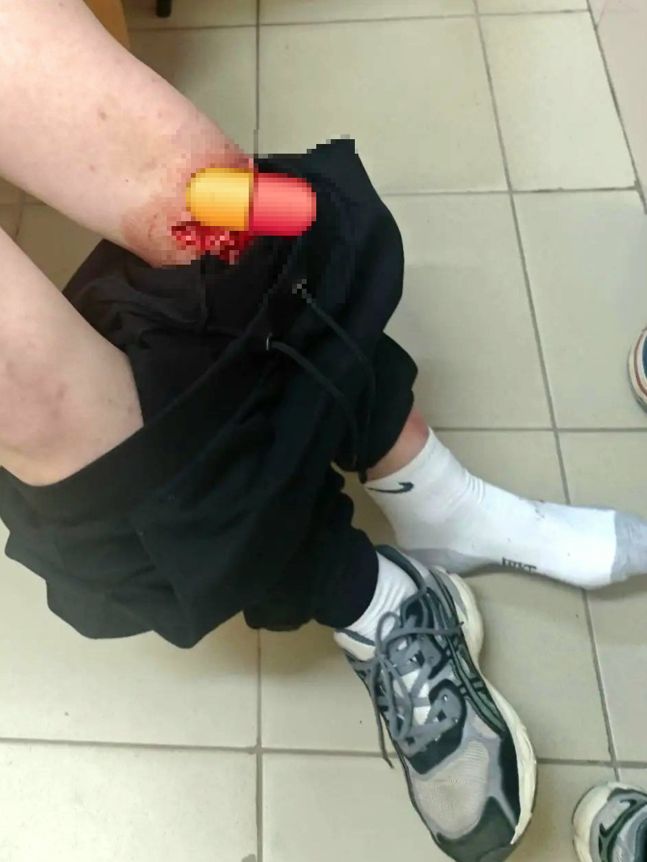 Кровоточащая травма колена у сидящего человека, часть раны скрыта цензурой