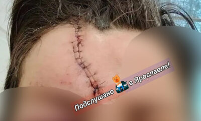 Шов на лбу женщины после травмы